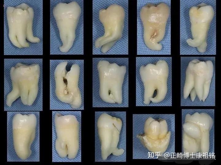 的牙套暴力拉扯,会使牙槽骨的重建追不上吸收,严重的还会引发牙根吸收