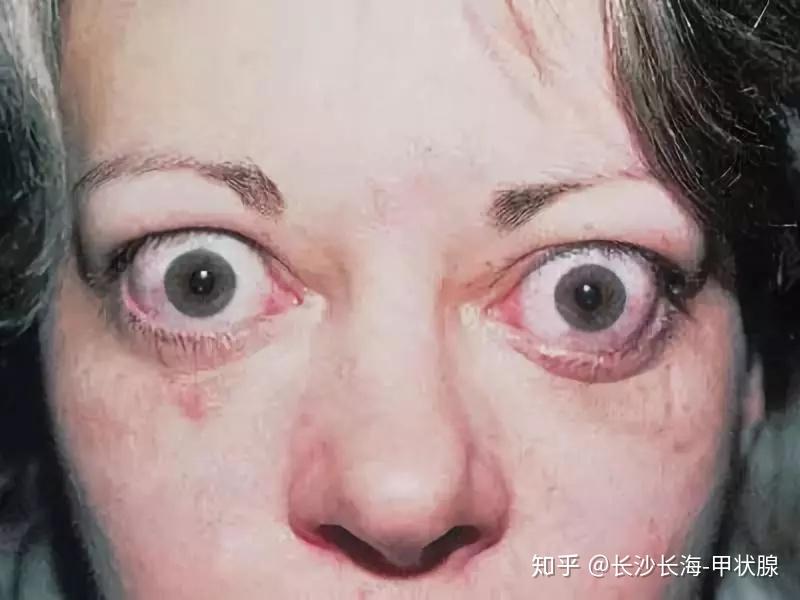 为轻度突眼仅表现为眼睑迟落,眼睑退缩(瞪眼),兔眼和单纯的眼球突出