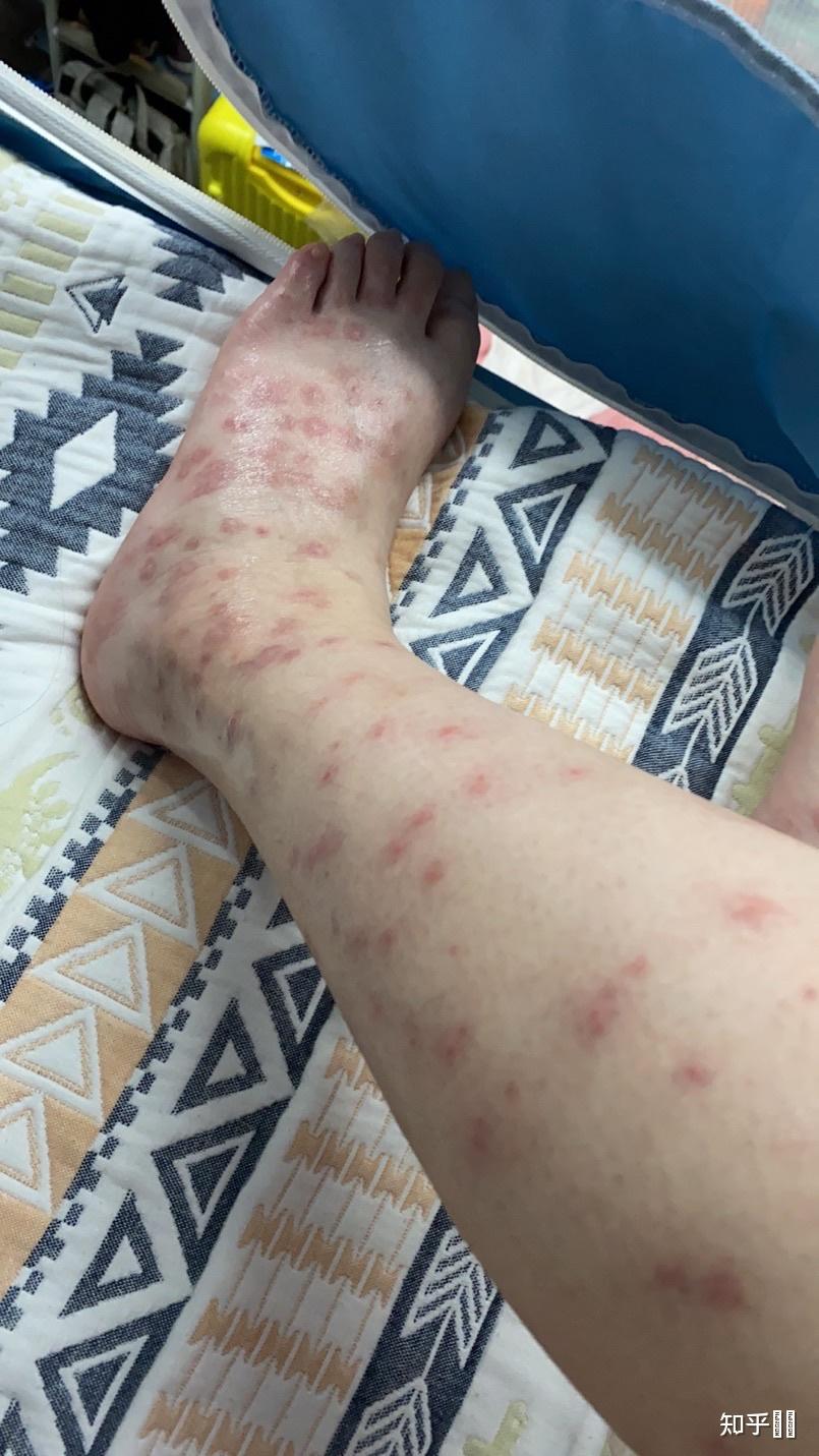 在南方被毒蚊子咬是一种怎样的体验
