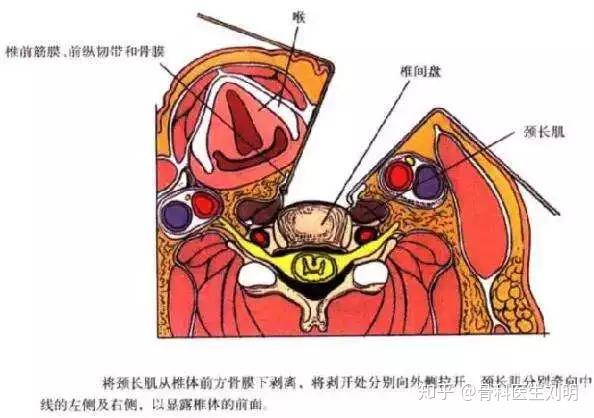 话说颈椎病要在脖子上开刀危险吗带你3分钟了解颈椎前路手术