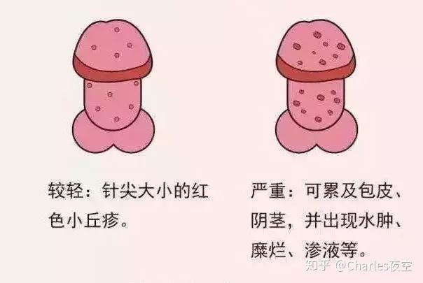 症状三另外如为霉菌感染性的念珠菌性龟头炎,症状为为龟头粘膜红斑