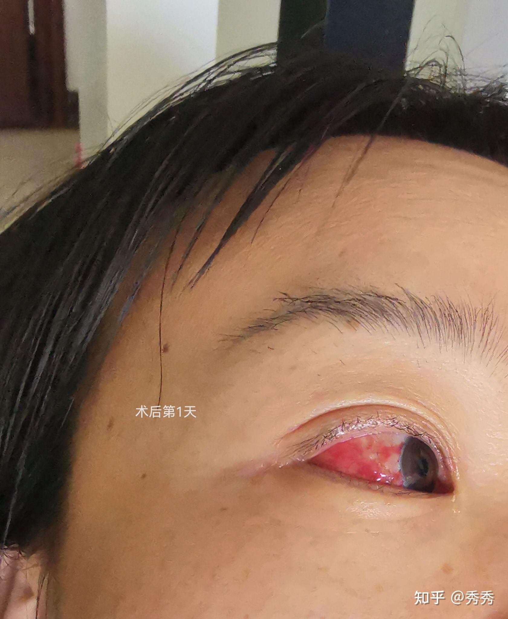 眼结膜囊肿手术前后对照