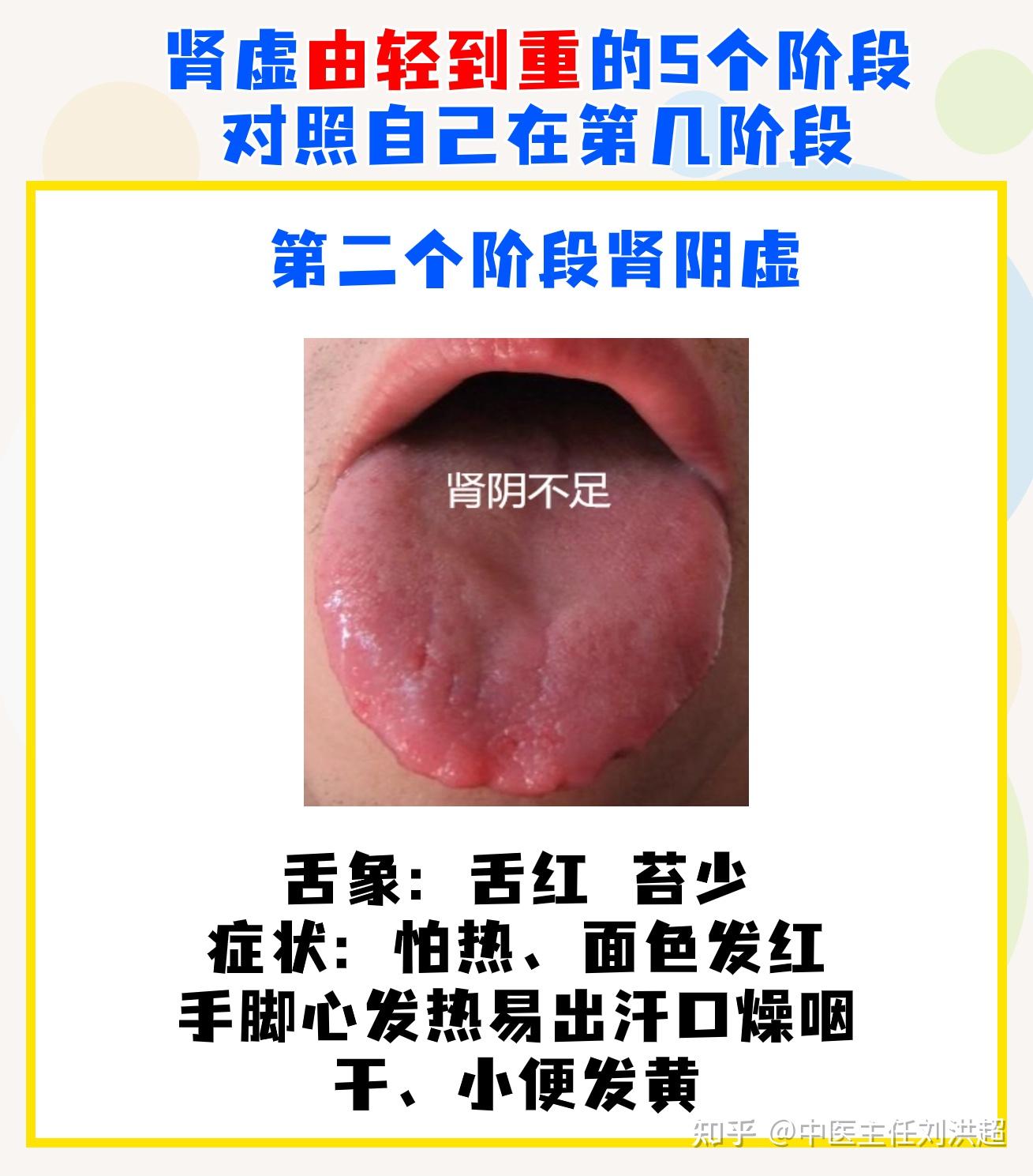 肾虚共有5个发展阶段,舌象及对应表现,对照自己发展到哪一步? - 知乎