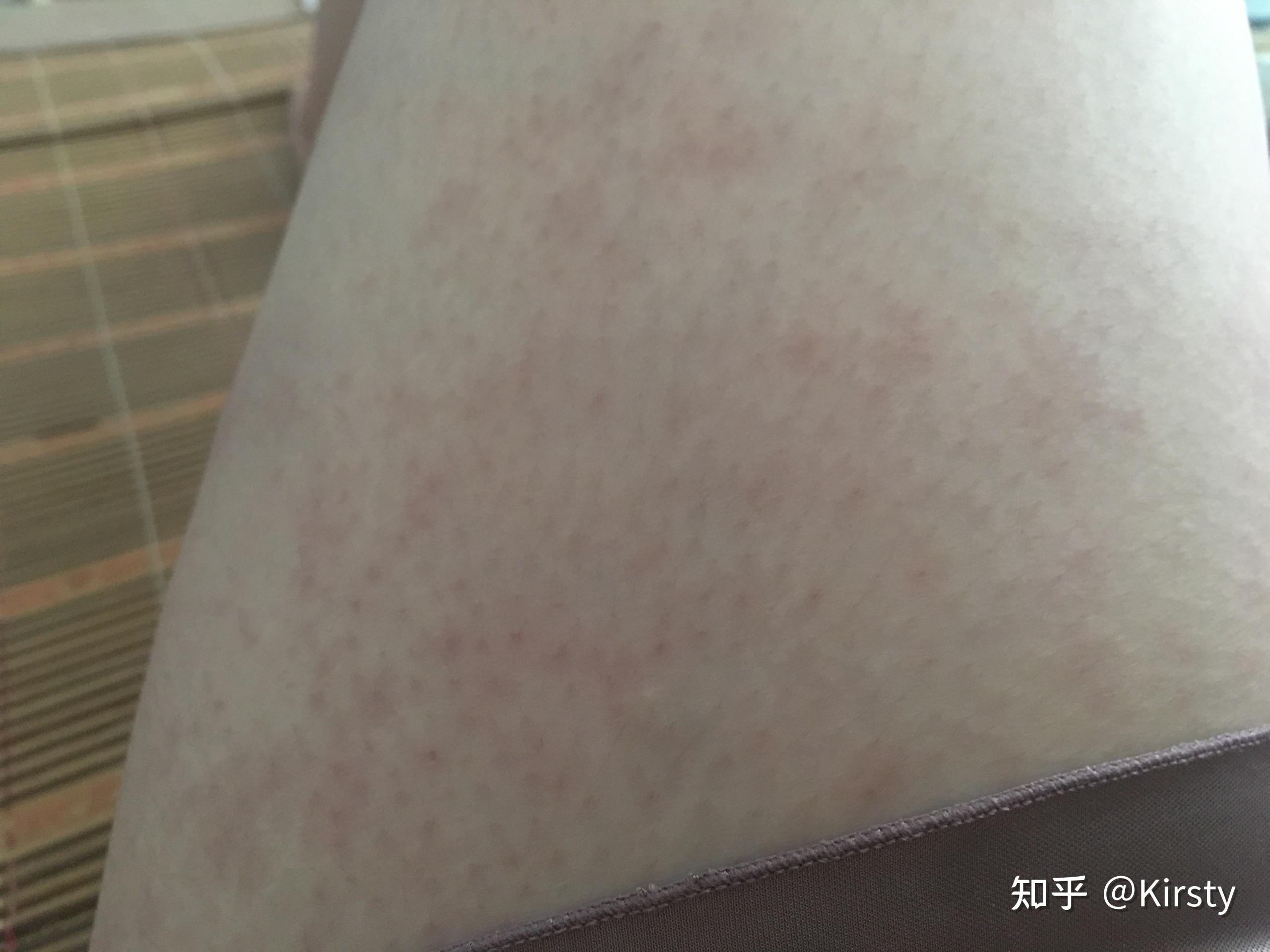 接种新冠疫苗后,我过敏了