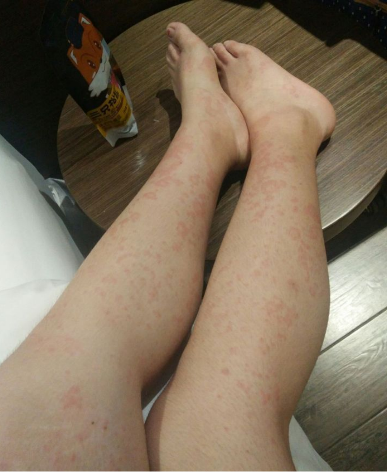 女性腿部湿疹图片图片