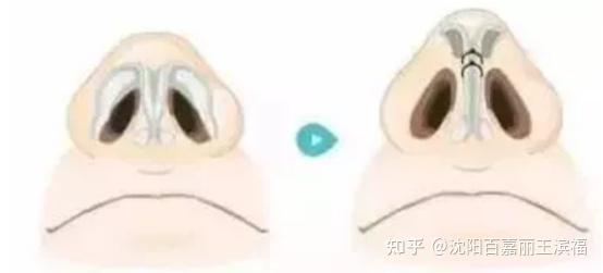 鼻整形专家，沈阳百嘉丽王滨福教授 - 知乎