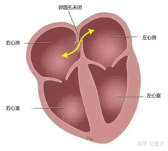 卵圆孔未闭解剖图图片