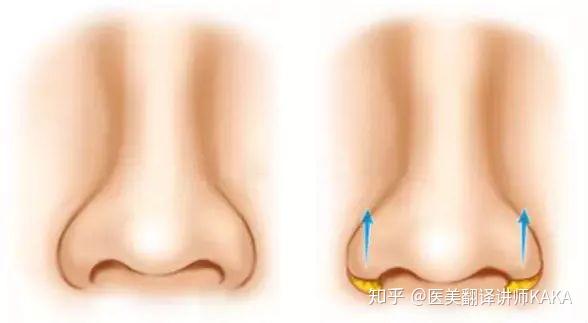 日本鼻部整形扫盲大全 知乎