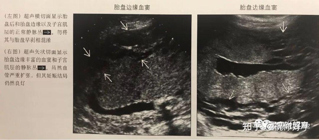胎盘早剥的超声诊断 - 知乎