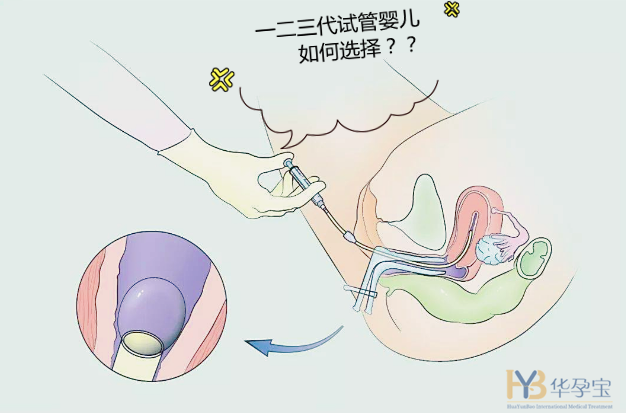 人工助孕方法一次图片