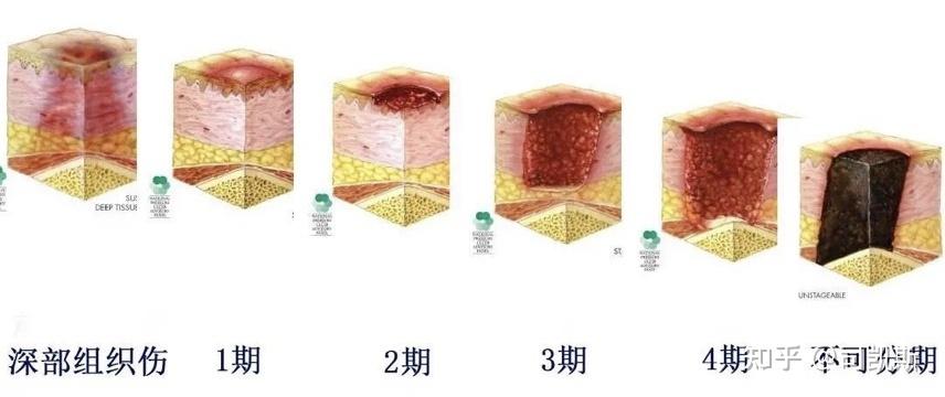 不可分期壓力性損傷:表現為傷口表面被壞死組織和焦痂覆蓋,無法明確