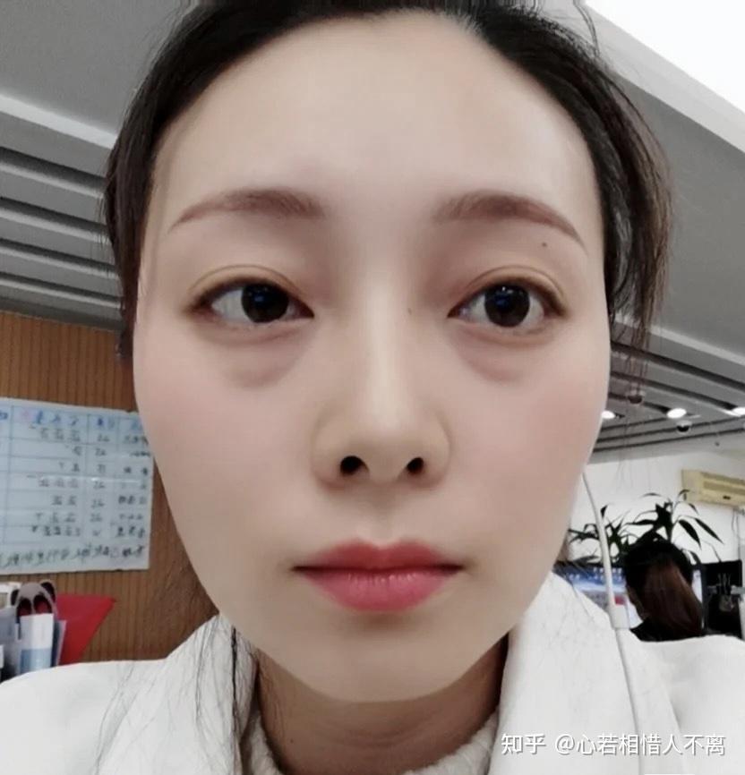 眼袋真的挺显老的