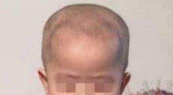 孩子的头大头小偏头方颅是什么原因一次性弄清楚