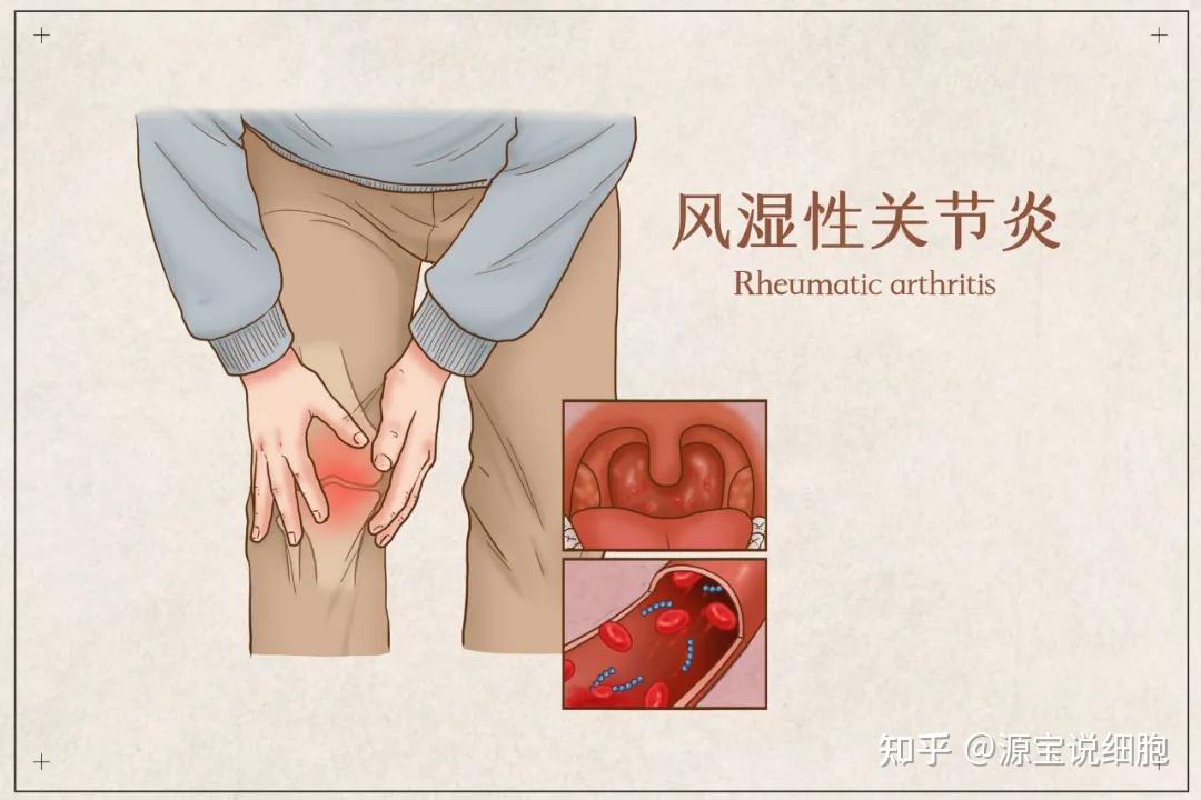 臨床研究幹細胞技術讓11年的類風溼性關節炎患者康復