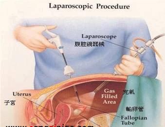 腹腔镜手术不是微创手术吗为什么还要全身麻醉很多人都搞错了