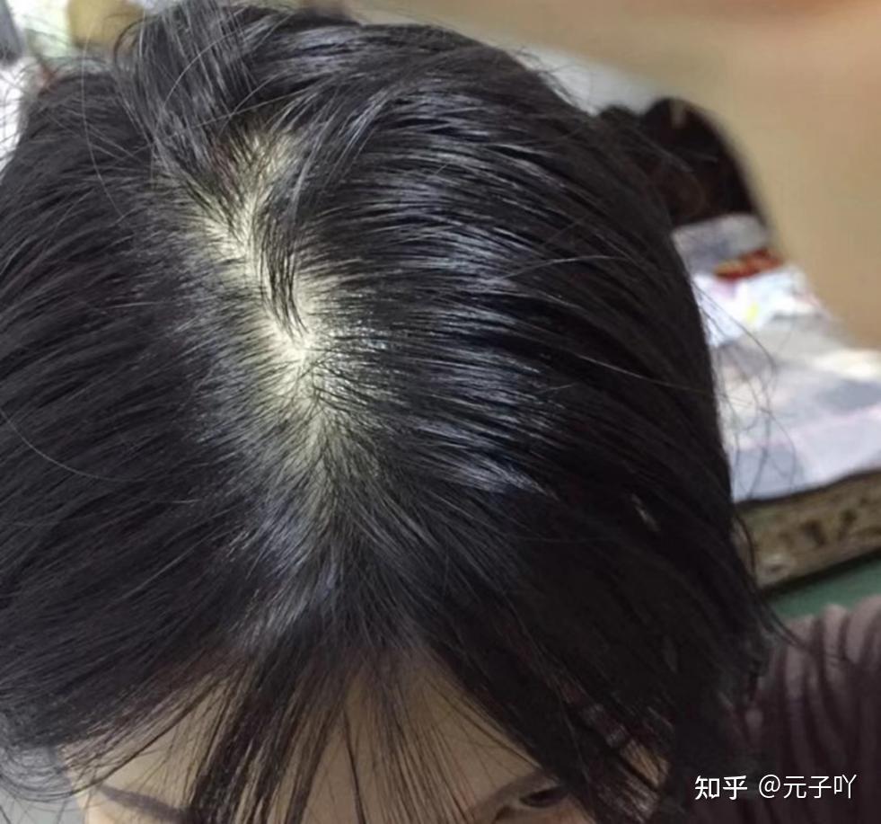 熬夜脱发严重出油快,有什么可以控油去屑的防脱洗发水值得无限回购?