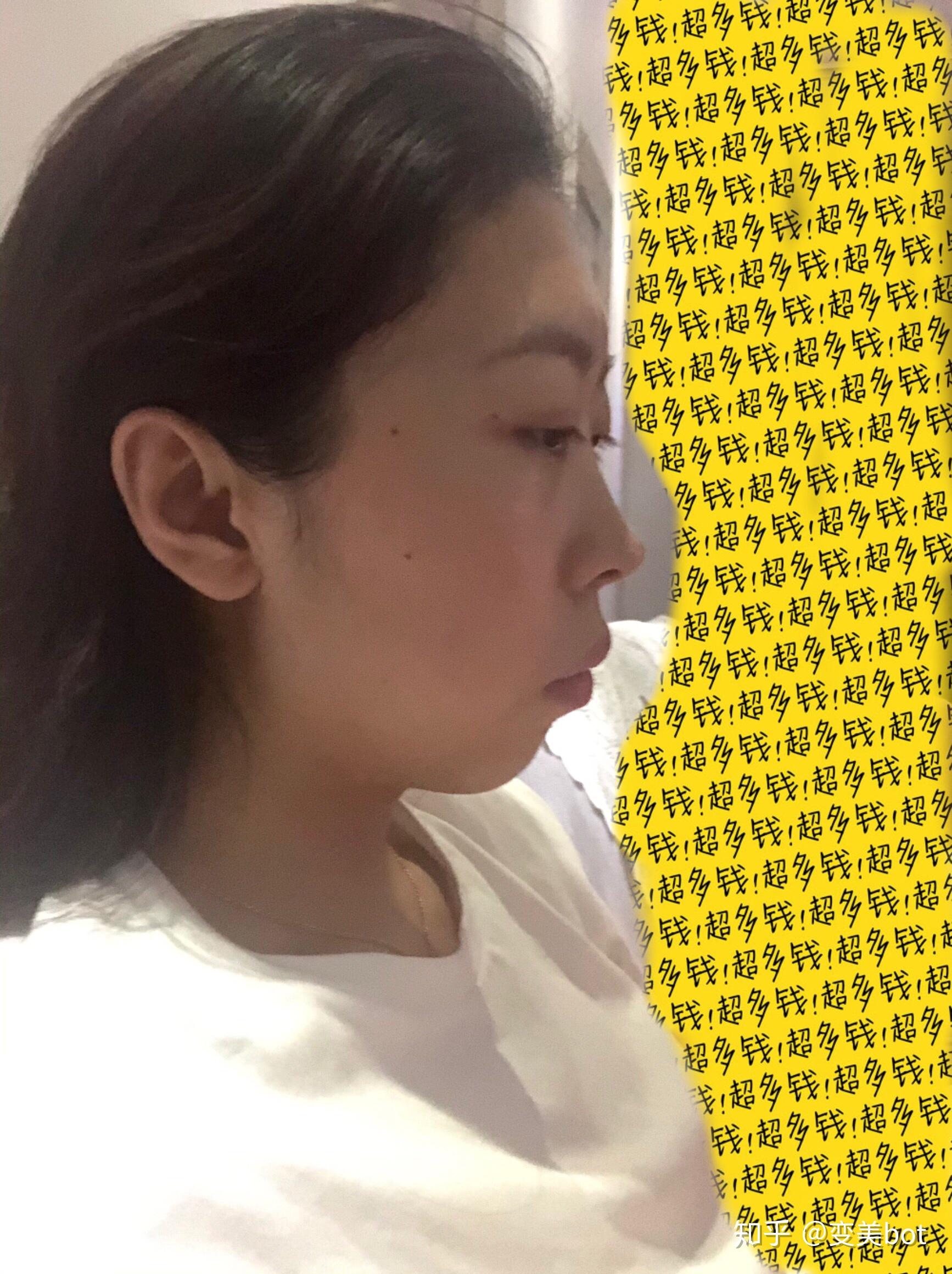 下巴短会感觉轻微的嘴凸凸嘴还是有很多种情况:牙性的,鼻基底凹陷