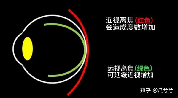 近视离焦 - 知乎
