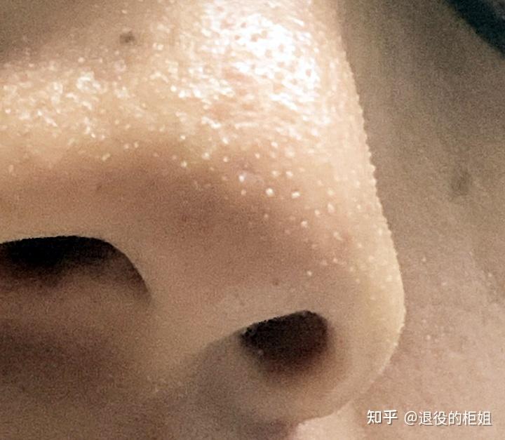 虽然我们每天都洗脸,但是毛孔里仍旧有很多堵塞物,其中最多的就是鼻子