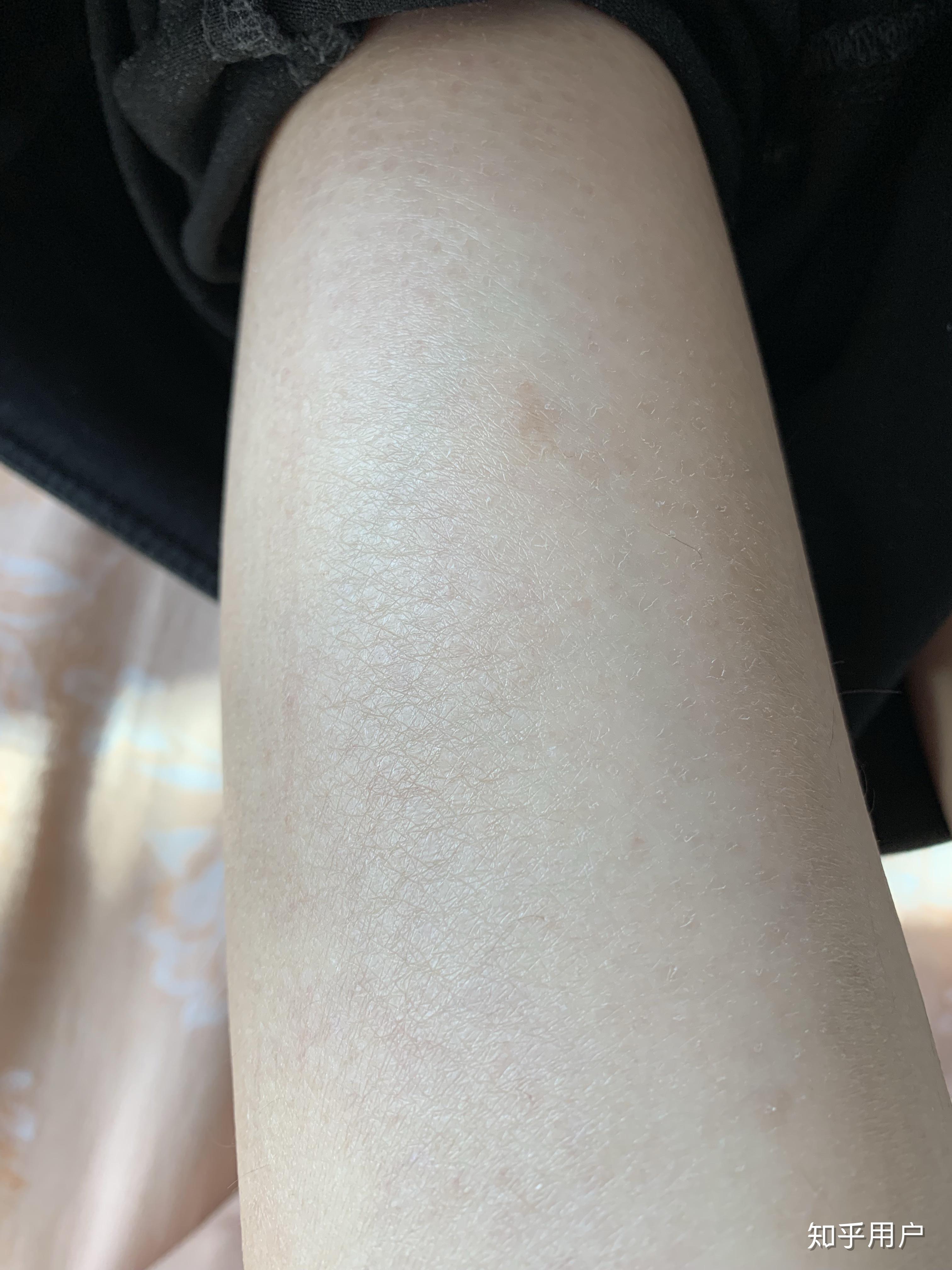 在干燥的北方浑身干燥腿部起皮屑甚至出现格纹很不舒服该如何给全身