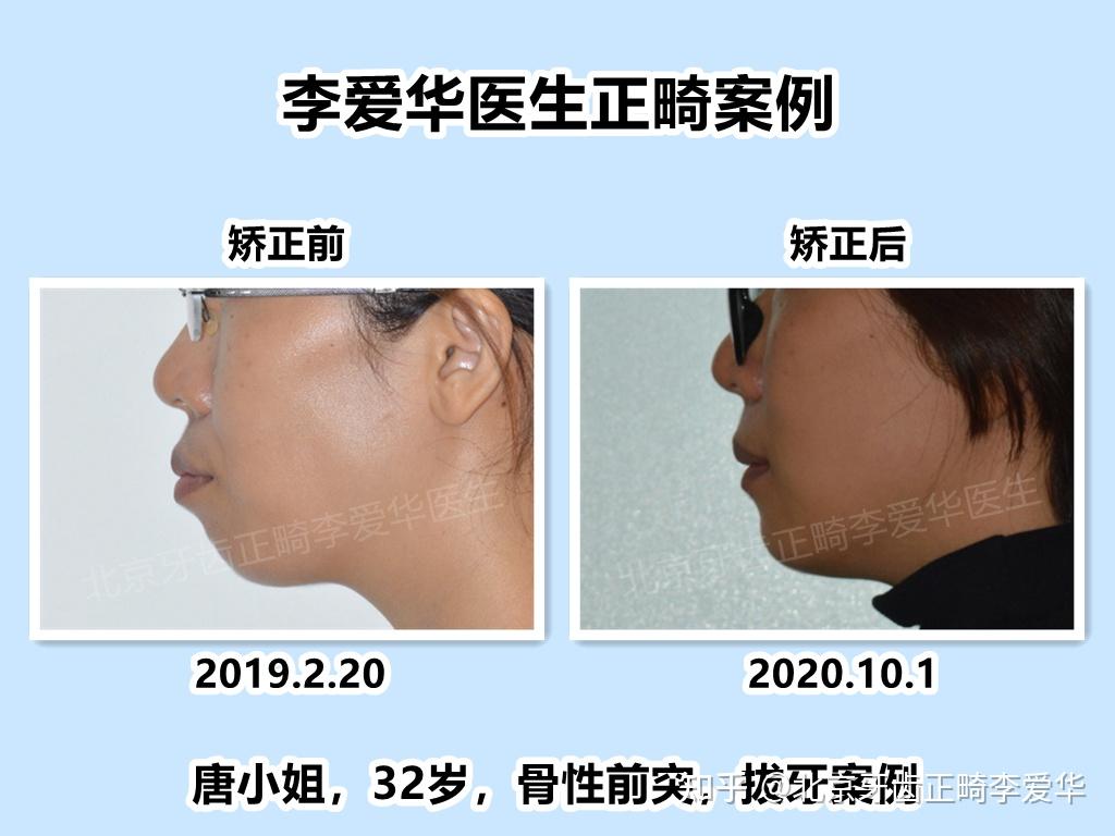 北京牙齿矫正下颌后缩矫正