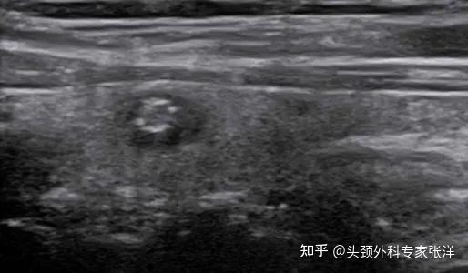 甲状腺结节发生了钙化,一定是癌变吗? - 知乎