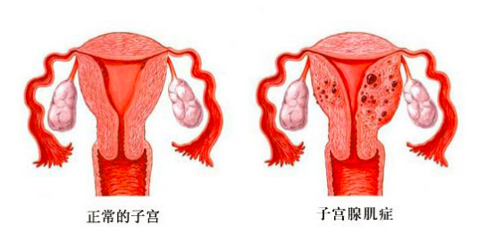 卵巢早衰试管移植成功率高吗