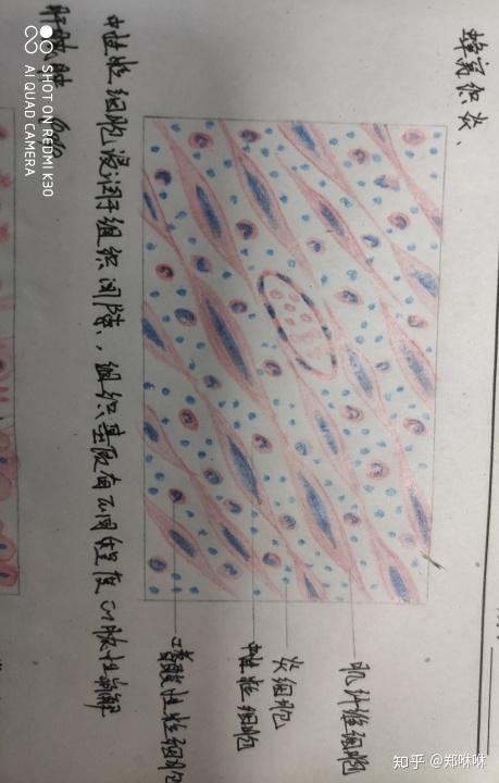 朗格汉斯细胞红蓝铅笔图片