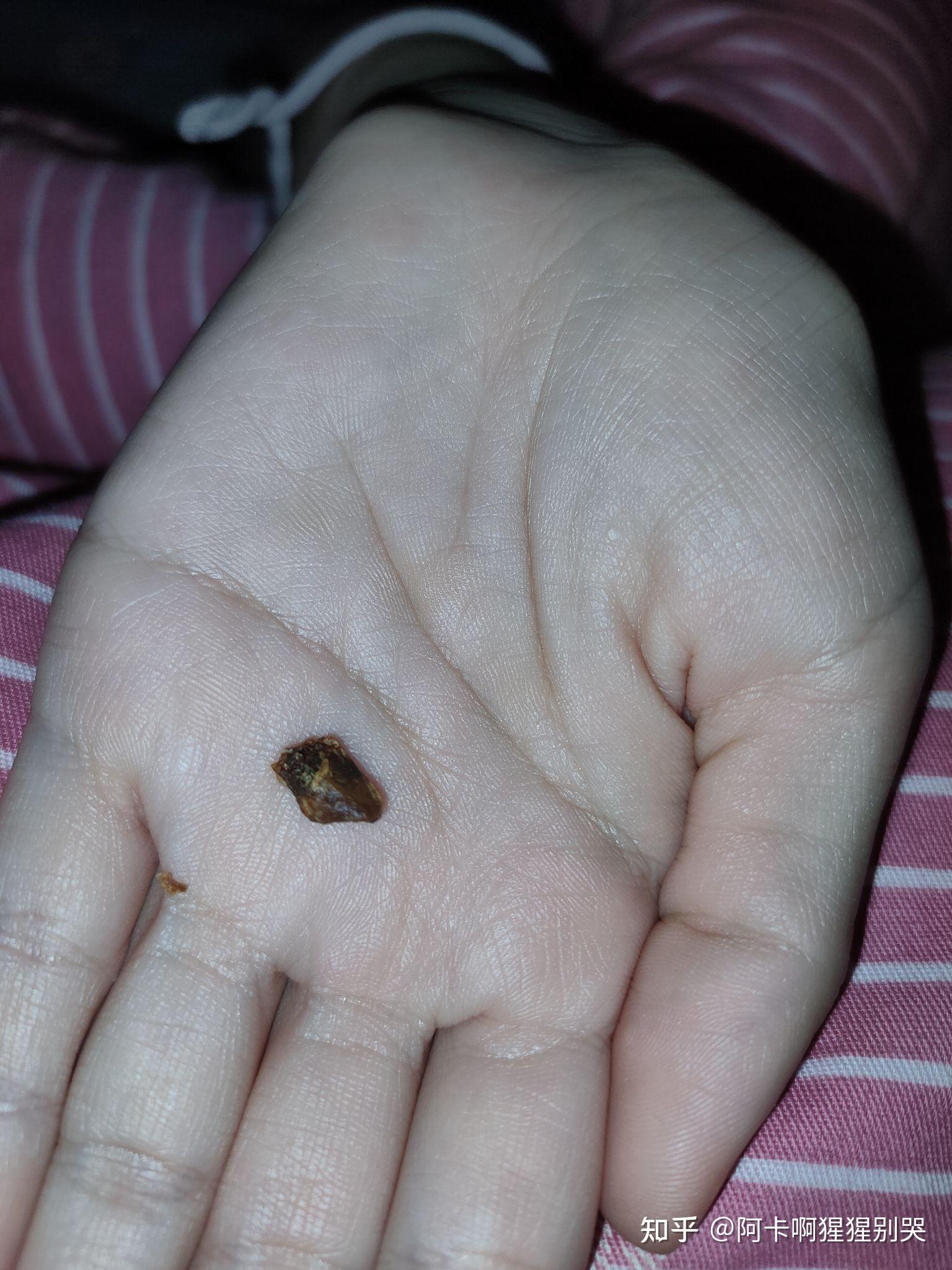 掏出一块超大耳屎是种什么体验