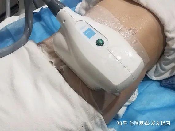 负压吸脂|水动力吸脂|冷冻溶脂|5g天使光雕|光纤溶脂超全解析!