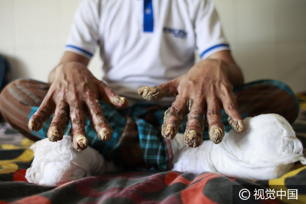 孟加拉国26岁男子患怪病手脚长树根异常可怕