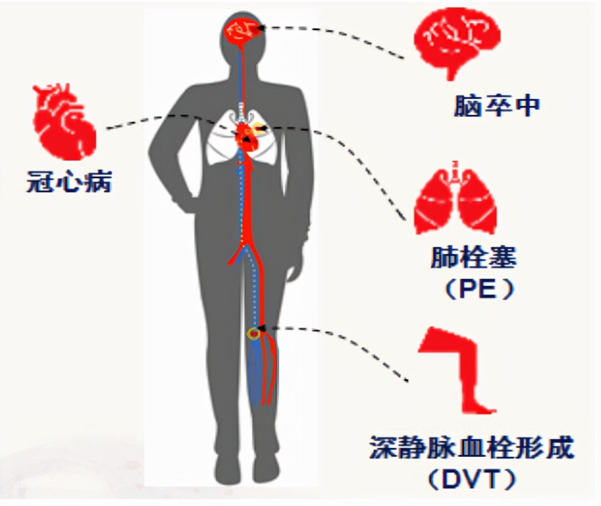 世界血栓日,防治血栓科普学起来 - 知乎