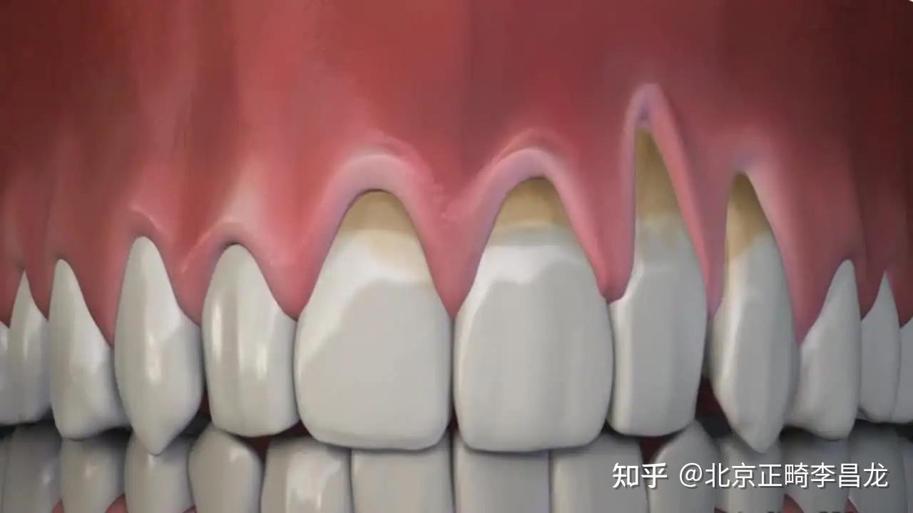 牙齿变长的原因有哪些?