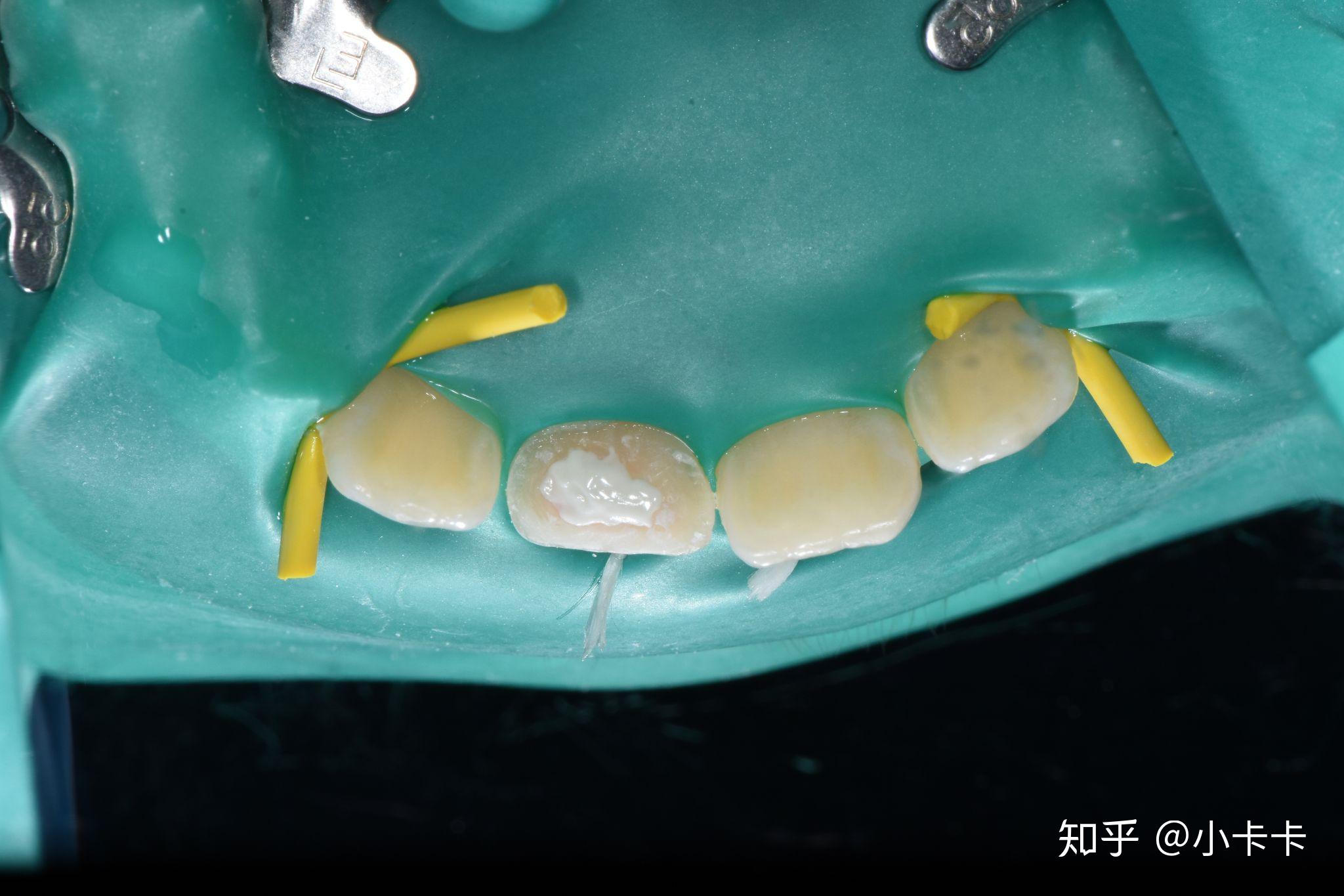 前牙外伤一周美塑树脂补牙一例