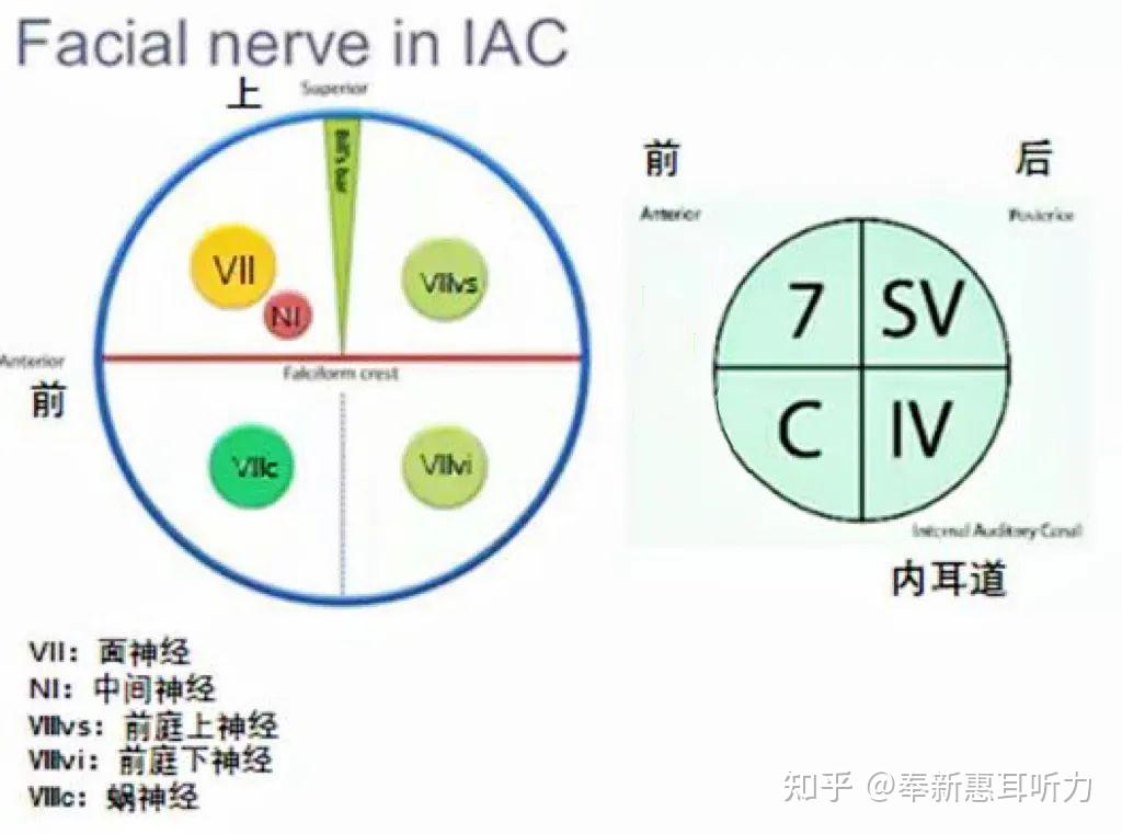 听神经细小系列科普|(一)如何精准诊断听神经细小(影像学特征 - 知乎