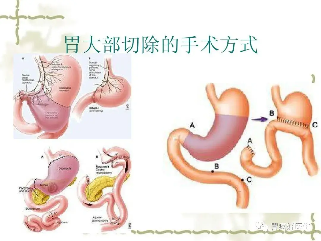 胃癌手术 图解图片