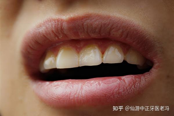 生活中很多市民朋友会发现自己的牙齿上会有一些不知名的横沟,一开始