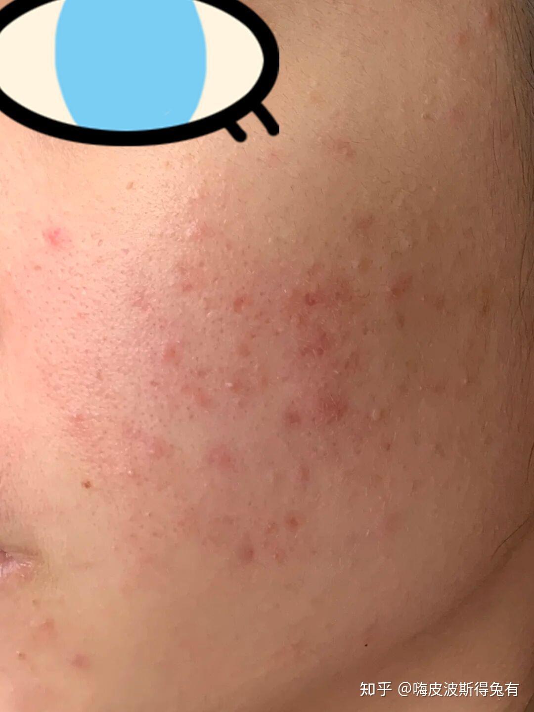 为什么脸上的痘印一直不好呢?