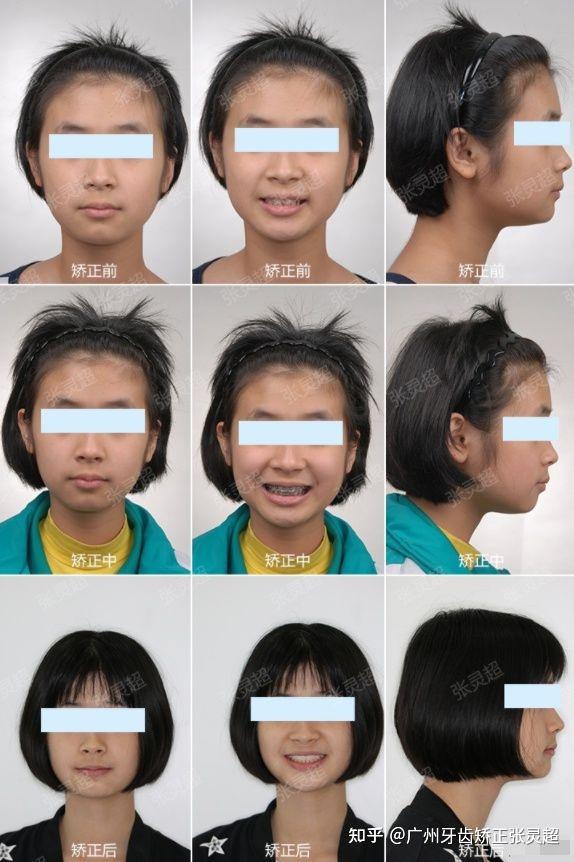 矫正前后面像对比