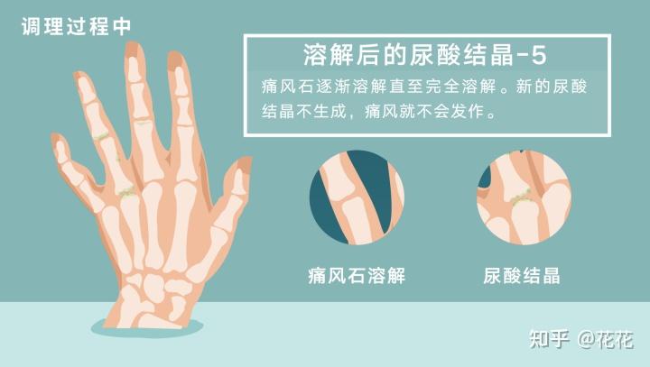 痛风高尿酸溶解尿酸盐结晶有什么反应?会痛吗?