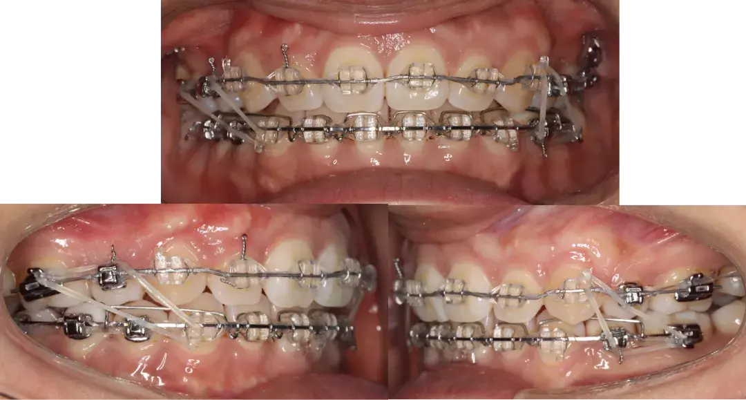 正畸病例拔4個4病例一例