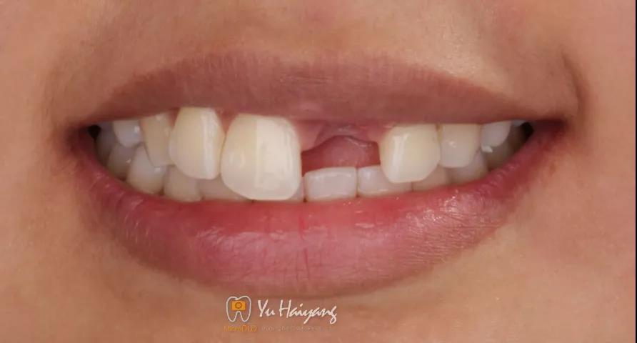 上颌中切牙外伤冠折后数字化即拔即种即修复92例 - 知乎