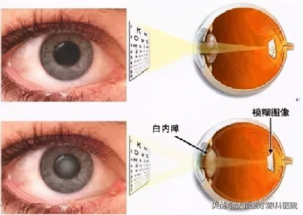白内障千万不能一拖再拖小心诱发青光眼