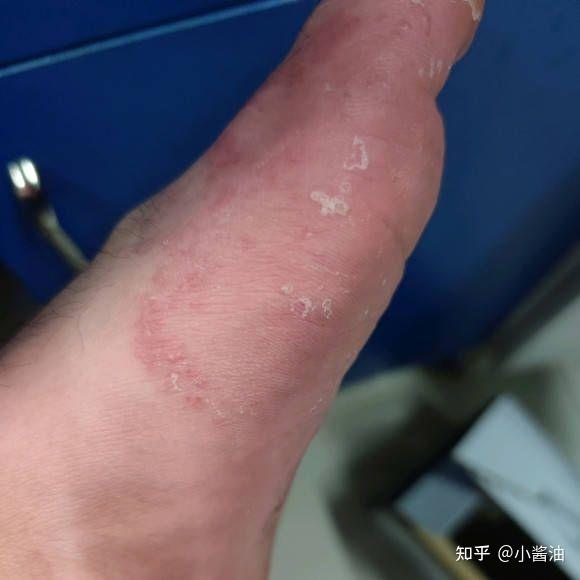 1,水泡型脚气大多比较容易发生在足缘部,往往可在患处出现小水疱,壁厚
