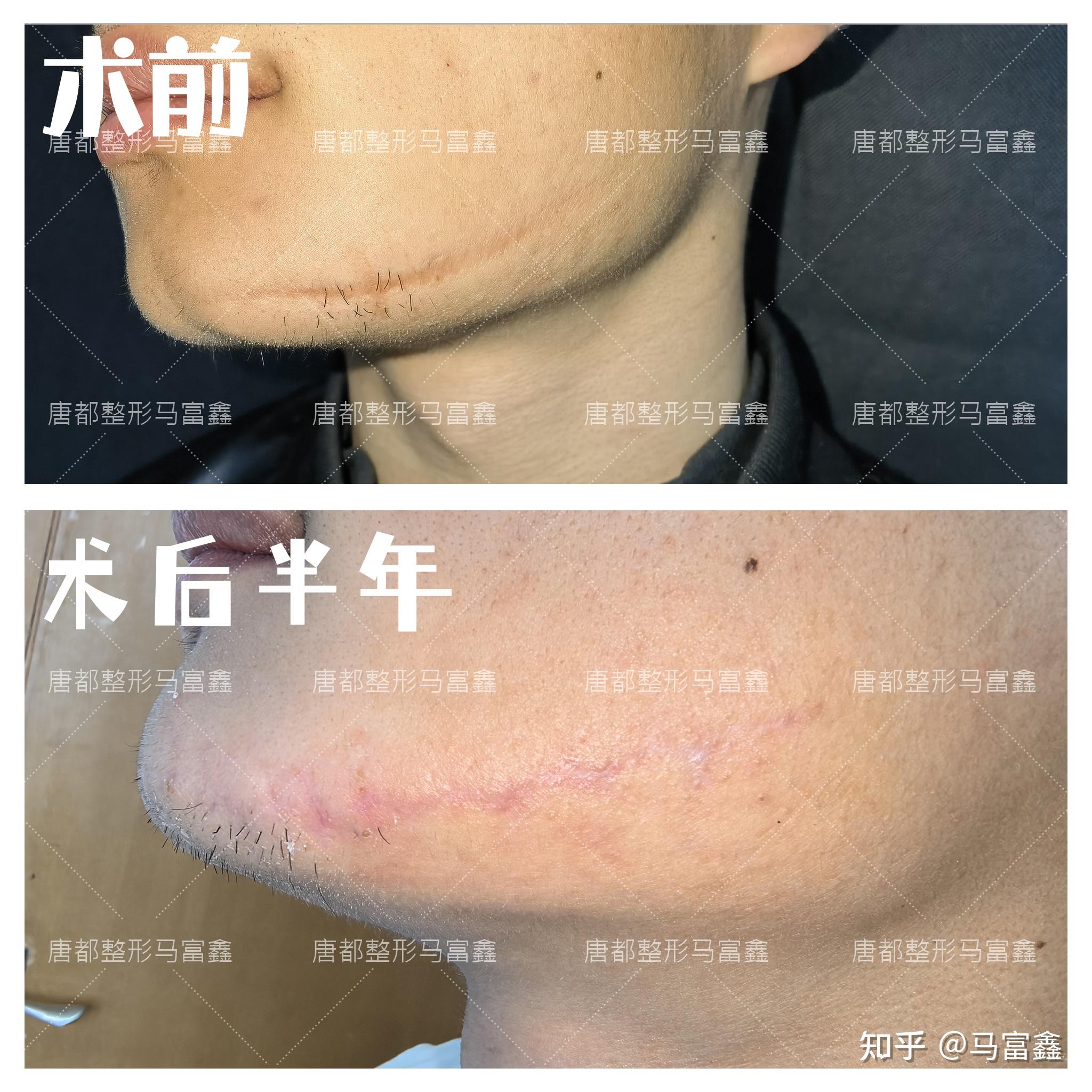 下颌部瘢痕手术