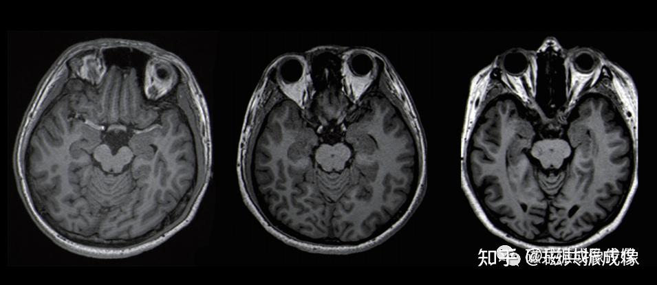 颞叶内侧癫痫患者杏仁核体积变化的临床研究 - 知乎