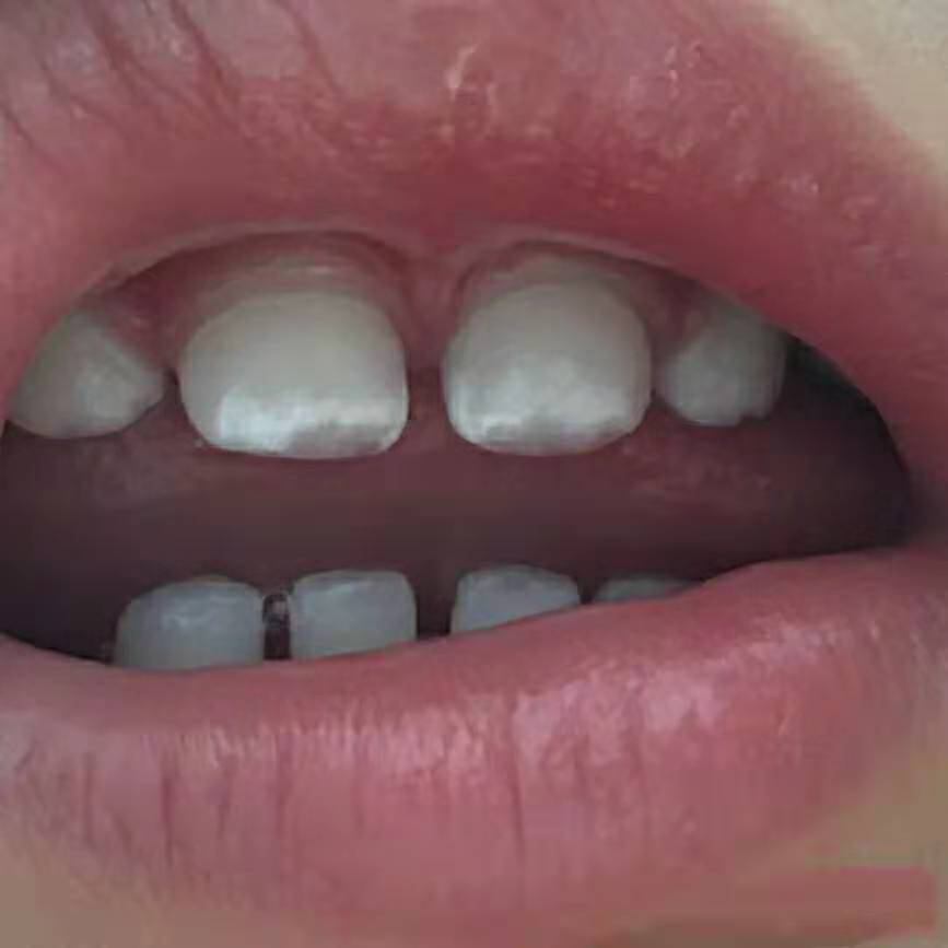 儿童牙齿钙化图片
