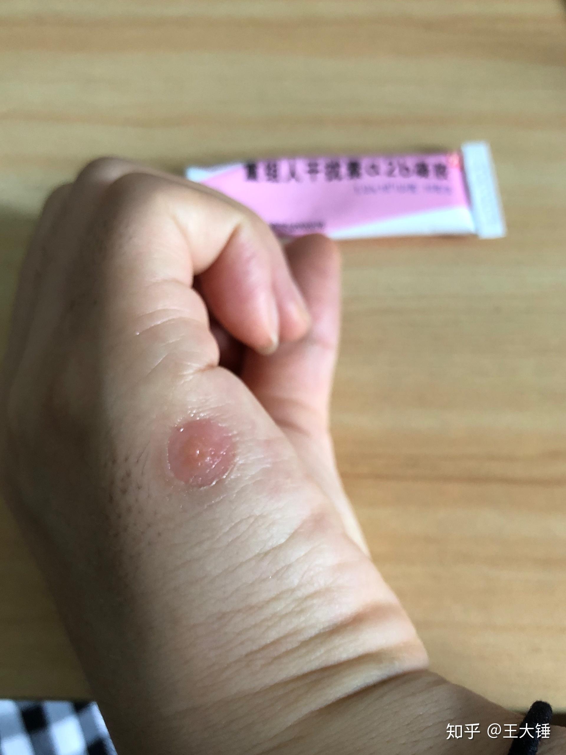 冷冻疣过程记录