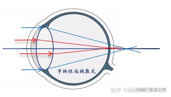 认识散光 - 知乎