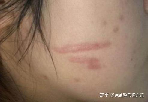 脸被人抓伤了怎么办? - 知乎